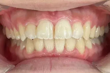 ガタガタ歯After