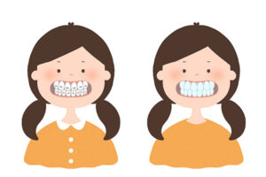 マウスピース矯正とは？