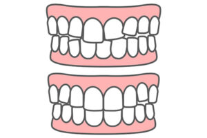 歯の矯正について